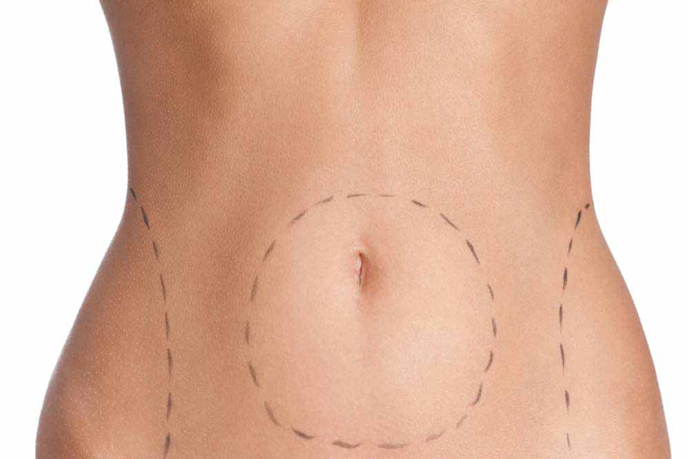 Belly correction marks