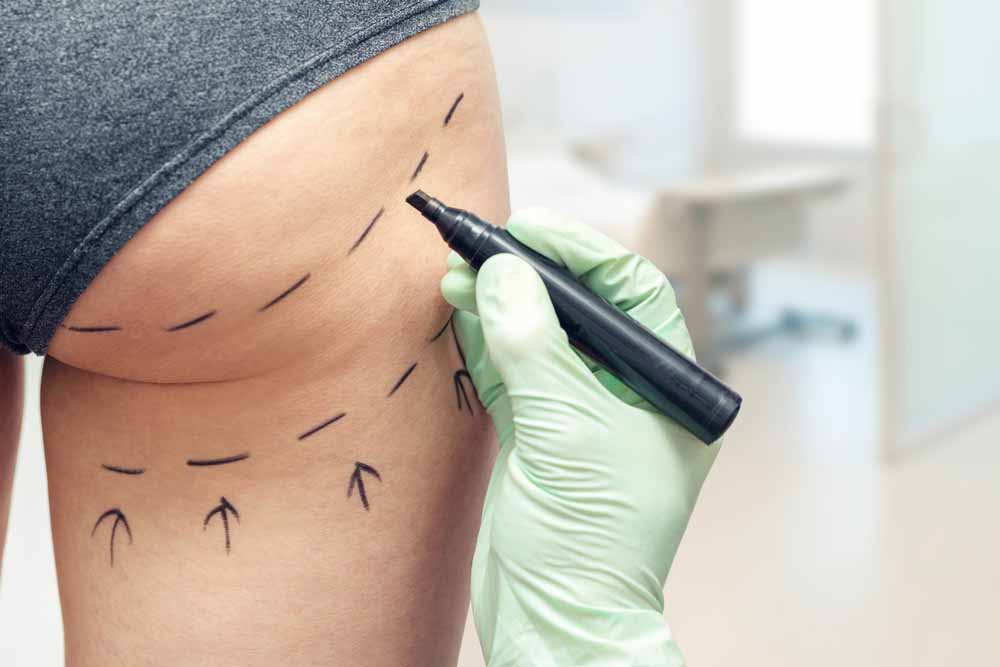 plastic surgeon marking womans body for surgery