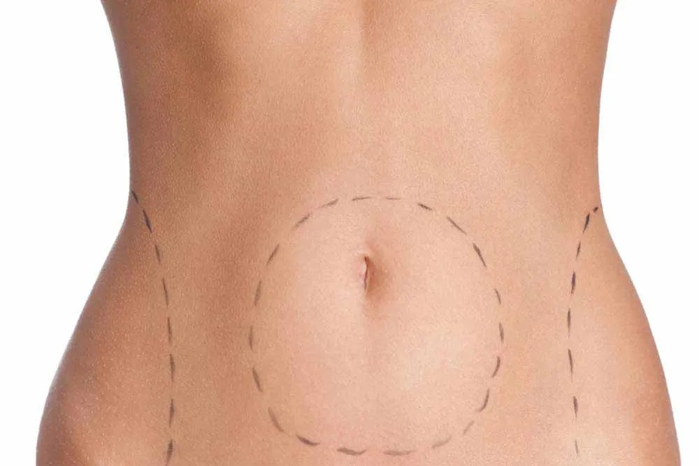 Woman's stomach with markings around the belly button and hips