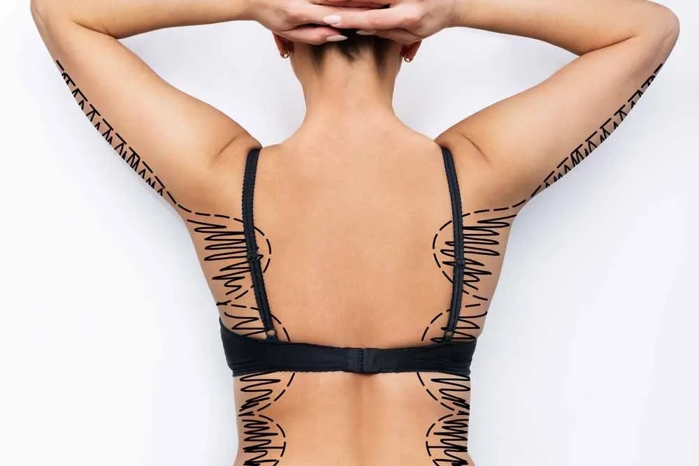 Woman's back with sharpie on it