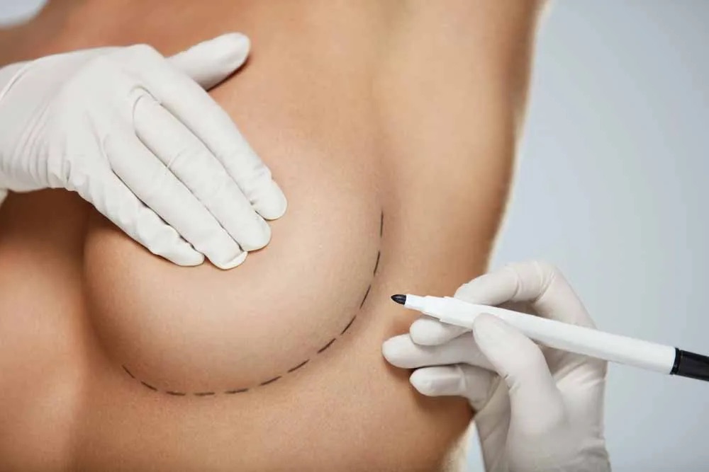 Surgeon drawing on marks under womans breast for breast lift