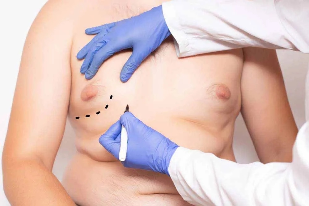 Surgeon making marks on mans gynecomastia