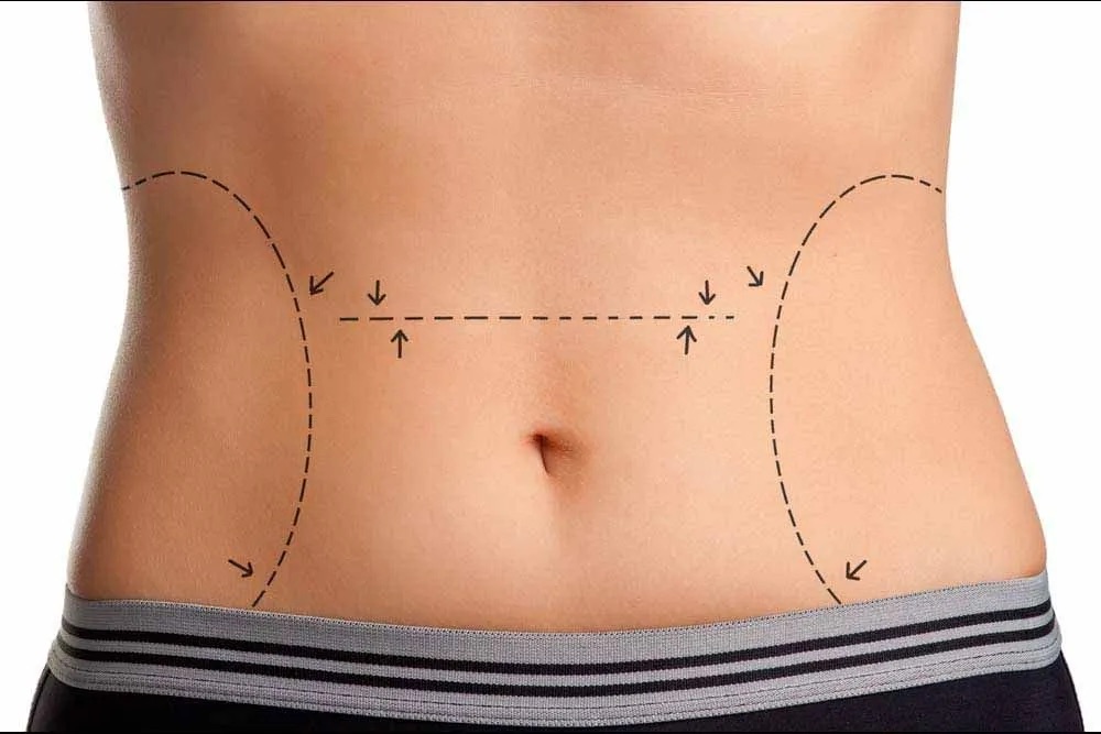 Markings for lipo 360 on woman's stomach