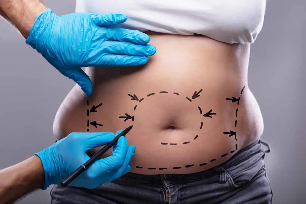 Surgeon drawing markings on woman's stomach for liposuction