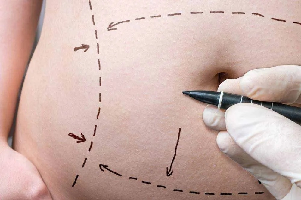 Surgical markings on patients stomach