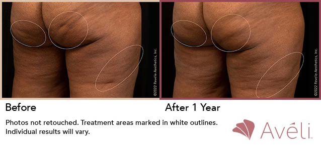 Before and after Avéli treatment